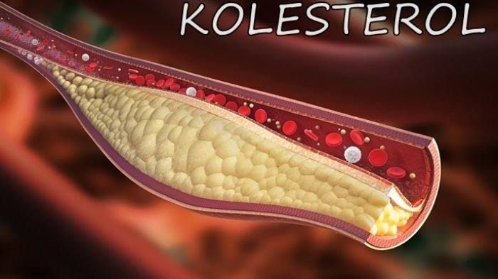 4 Jenis Makanan yang Harus Dihindari Penderita Kolesterol