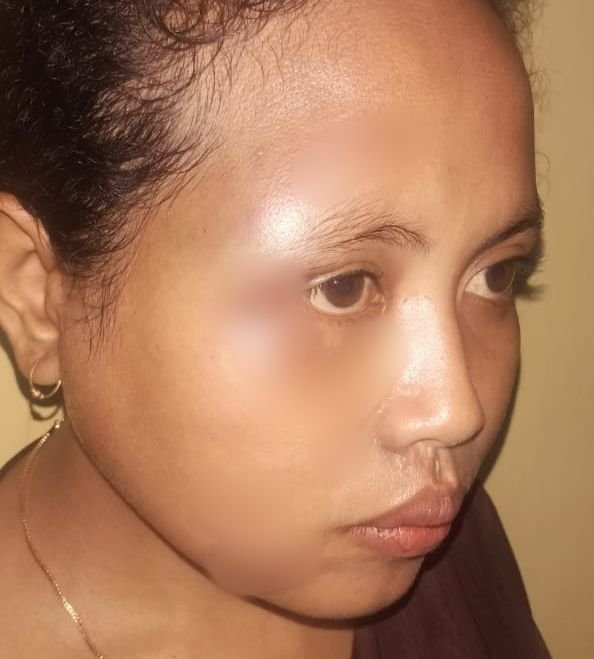 Setelah Lempar Suami dengan Batu, Seorang istri di NTT Babak Belur Dianiaya