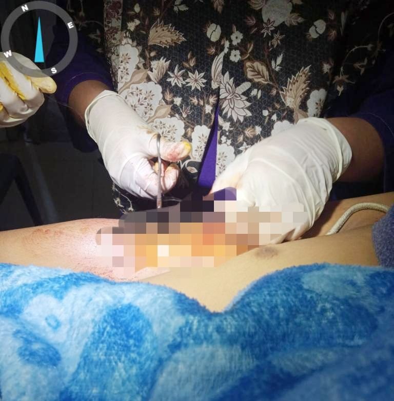 Rencana Tamasya ke Sibolangit, Tiga Pemuda Asal Marelan Nyaris Dibegal, Satu Korban Dibacok Tangannya