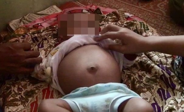 Bayi 5 Bulan 'Hamil' di Sumbar Akan Dioperasi Besok