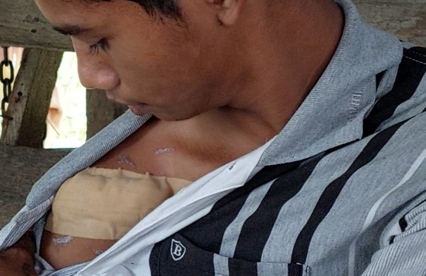 Remaja di Langkat Dibacok Kawanan Begal Bersajam, Luka Hingga 25 Jahitan