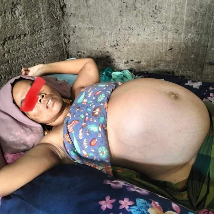 Ibu Penderita Perut Buncit di Panyabungan Butuh Uluran Tangan